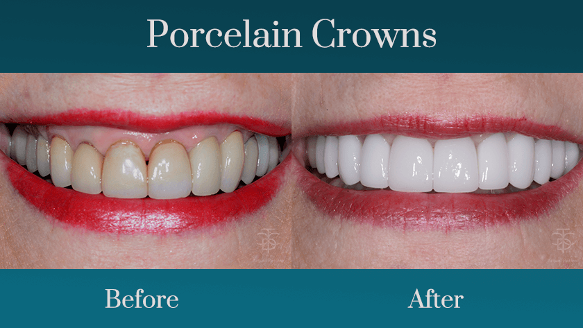all porcelain crowns - before